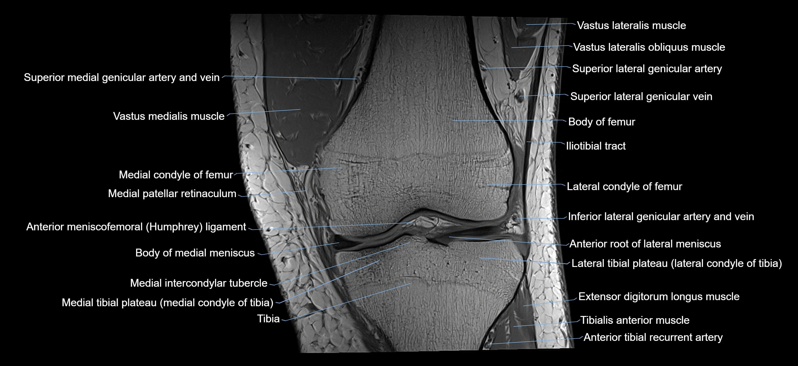 MRI knee coronal cross sectional anatomy labelled 3T radiology  image-04001-00017.webp